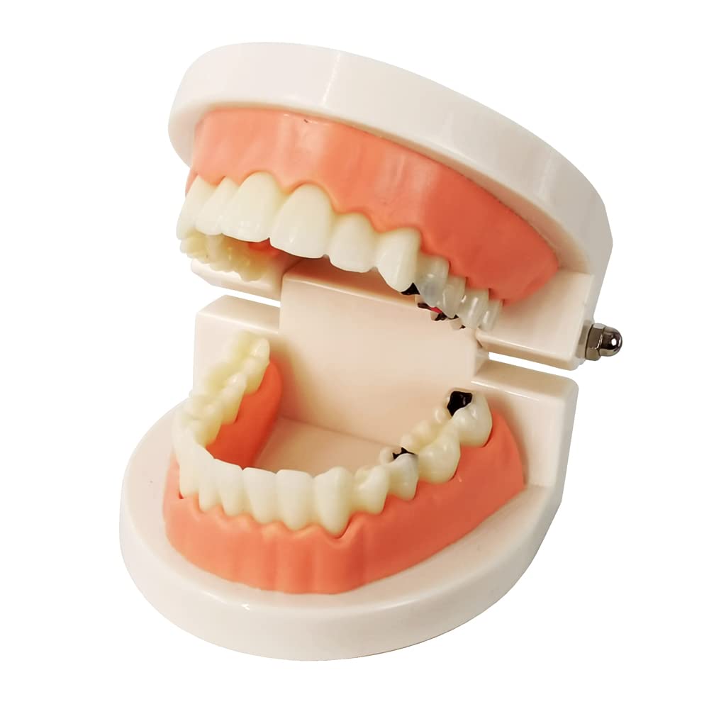 Evotech Scientific Decay Teeth Model, Dental Teeth Model Caries Standard Teeth Teaching Model Study Tool Adult Disease Standard Typodont Demonstration Teeth Model