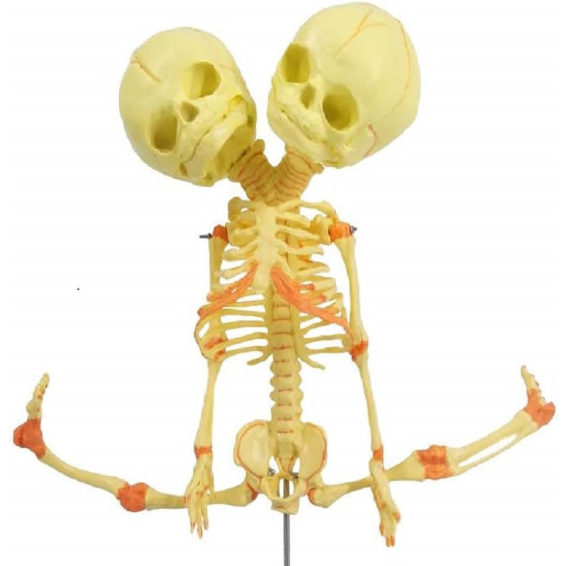 Evotech Scientific Human Infant Skeleton Model, Twin-Skull, Human Fetus Skeleton W/Double-Skull Model