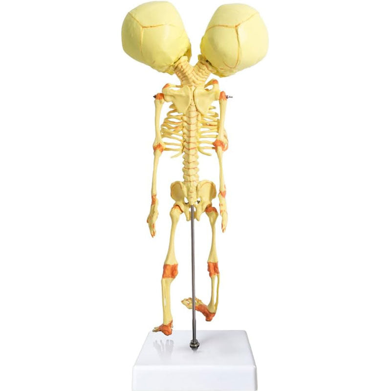 Evotech Scientific Human Infant Skeleton Model, Twin-Skull, Human Fetus Skeleton W/Double-Skull Model