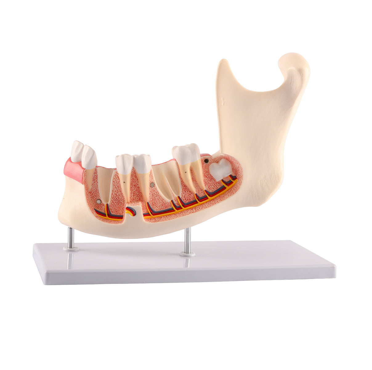 Evotech Scientific Half Lower Jaw W/ Nerve and Removable Teeth , 3x Life Size, 6 Parts