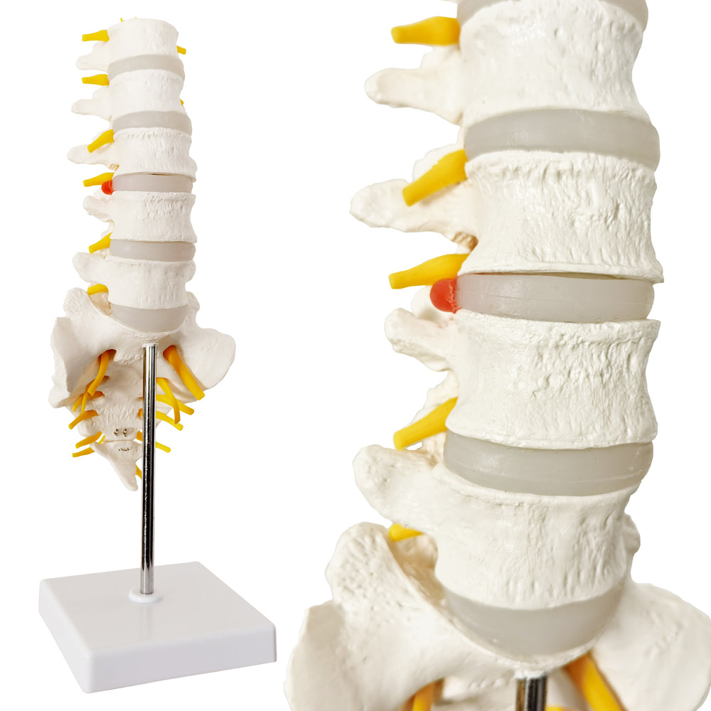 Evotech Scientific Lumbar Vertebral Column with Sacrum and Spinal Nerves Anatomy Model, Herniated Disc at L4