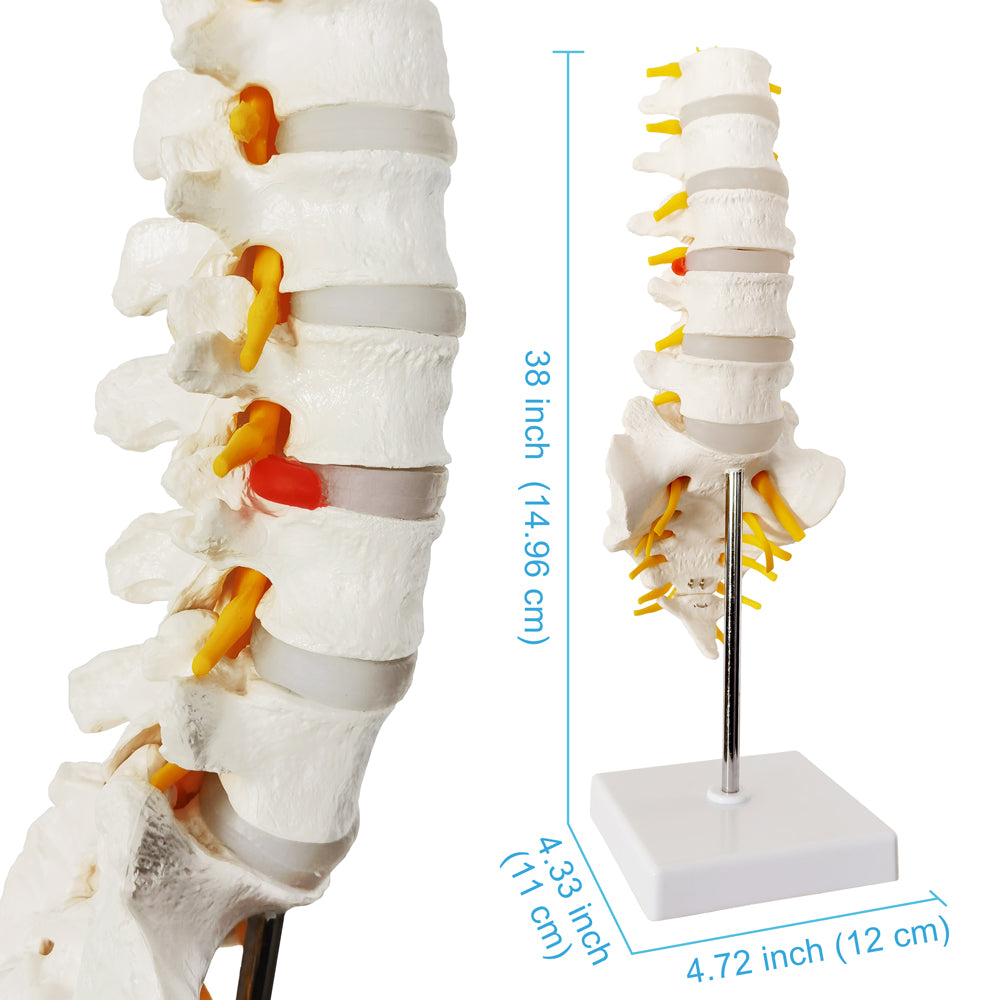 Evotech Scientific Lumbar Vertebral Column with Sacrum and Spinal Nerves Anatomy Model, Herniated Disc at L4