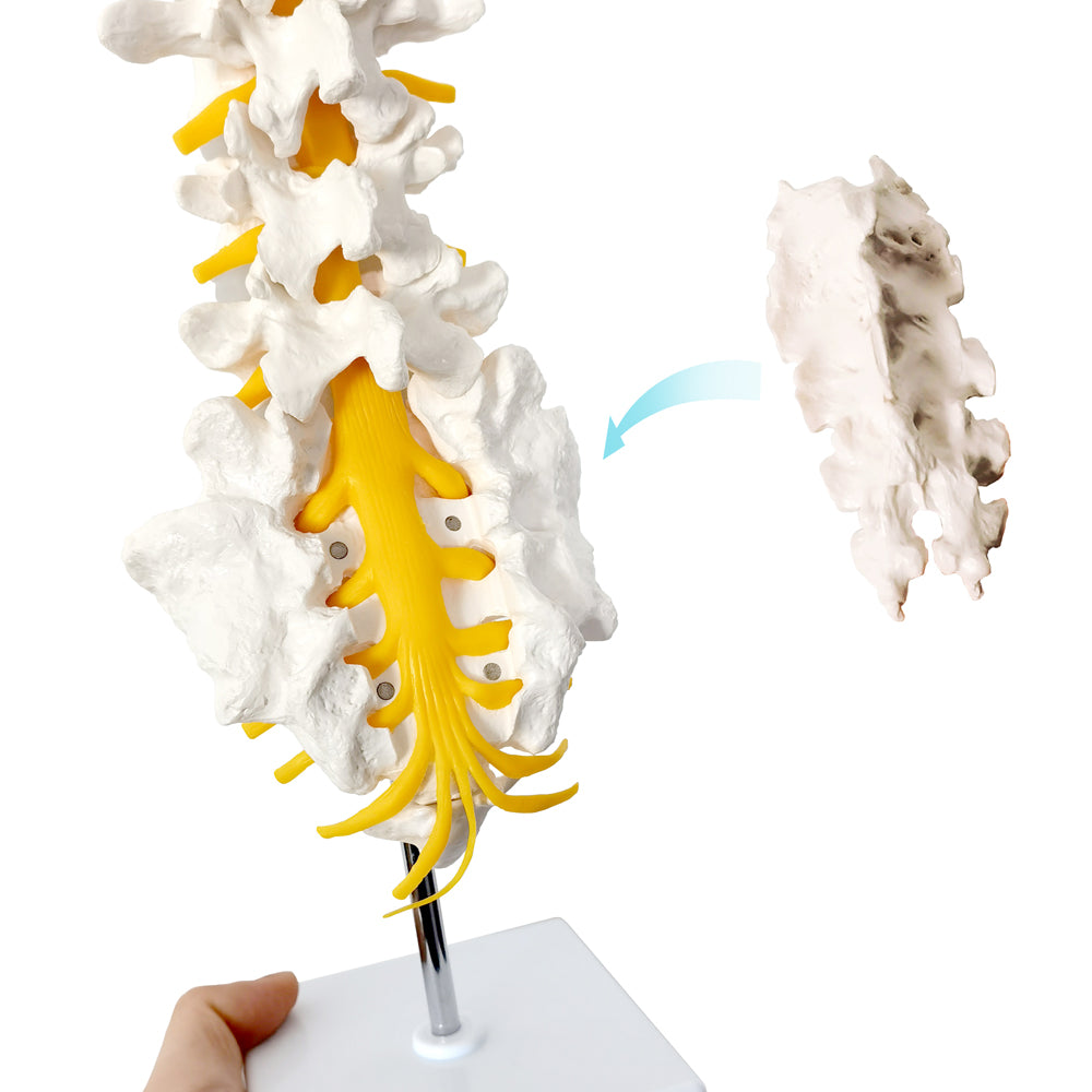Evotech Scientific Lumbar Vertebral Column with Sacrum and Spinal Nerves Anatomy Model, Herniated Disc at L4