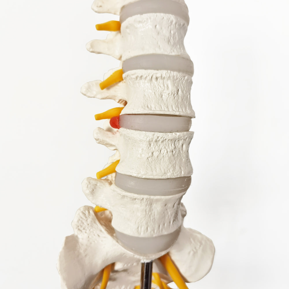 Evotech Scientific Lumbar Vertebral Column with Sacrum and Spinal Nerves Anatomy Model, Herniated Disc at L4