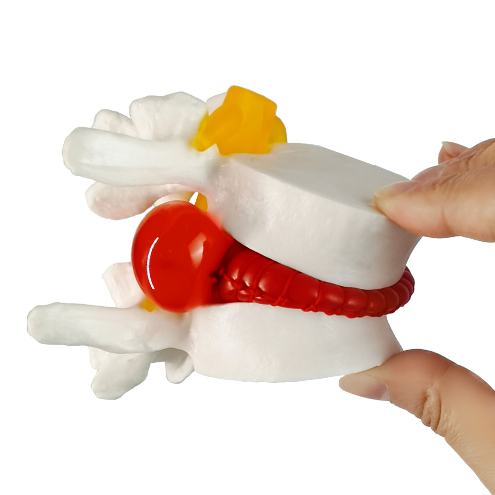 Evotech Scientific Human Lumbar Herniating Disc Demonstration Anatomy Model