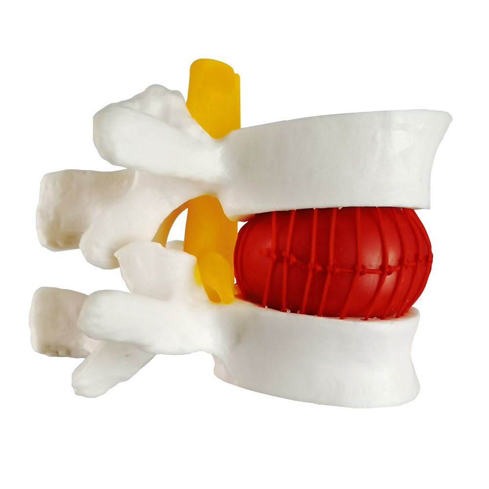 Evotech Scientific Human Lumbar Herniating Disc Demonstration Anatomy Model